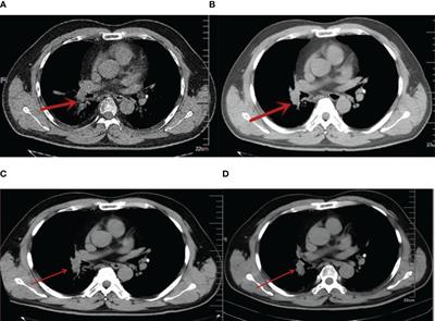 Long-term, 13-year survival after immune cell therapy combined with chemotherapy for extensive-stage small-cell lung cancer: a case report